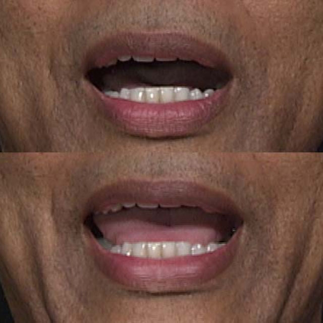 Two images of a mouth demonstrating lip reading